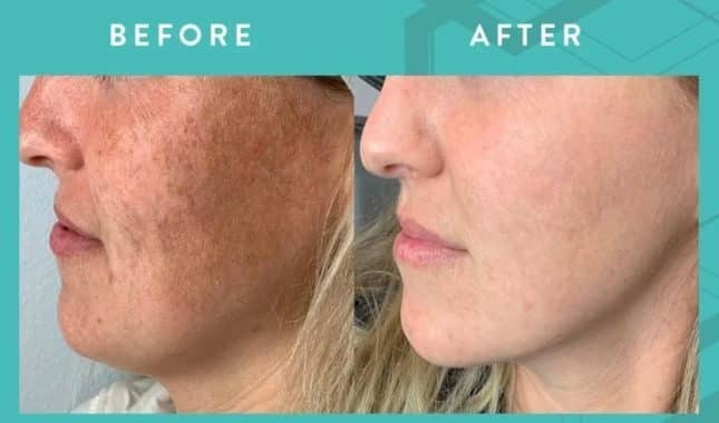 Lumecca PEAK Acajou Spa Ponsonby Before and After image.